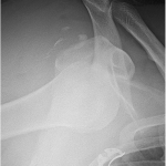 Fig. 1 Anteroposterior radiograph of the right shoulder shows anterior glenohumeral dislocation with many osseous fragments in the glenohumeral joint space. The humeral head is displaced medial and inferior to the coracoid process.
