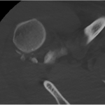 Fig. 2-A Multiplanar CT image of the right shoulder obtained after the attempted reduction reveals persistent anterior dislocation with multiple fracture fragments in the glenohumeral joint space.
