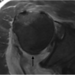 Fig. 3-A Axial proton density-weighted fat-suppressed, 3-D MRI view of the right shoulder shows the long head of the biceps tendon (arrow) posterior to the humeral head.
