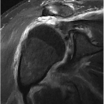 Fig. 3-B Coronal proton density-weighted fat-suppressed MRI shows portions of a massive rotator cuff tear with retraction of the myotendinous junction to the level of the glenohumeral joint.
