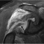 Fig. 3-C Coronal proton density-weighted fat-suppressed MRI at a level posterior to the image in Fig. 3-B reveals that the long head of the biceps tendon (arrow) is posterior to the humeral head.
