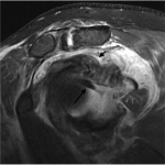Fig. 3-D Sagittal proton density-weighted fat-suppressed MRI of the right shoulder shows the long head of the biceps tendon (long arrow) extending posteriorly from the biceps anchor. A massive rotator cuff tear (short arrow) is also present.
