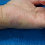 Fig. 1 Physical examination revealed a slightly elevated, light blue-red papular mass measuring 2 cm in diameter, located at the junction of the glabrous and nonglabrous skin of the ulnar border of the hand, beginning 1 cm distal to the wrist crease.
