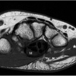 Fig. 2-A MRI of the mass of the hypothenar eminence. Axial T1-weighted image of the hand at the level of the metacarpal bases demonstrates an ill-defined mass (white arrow) isolated within the subcutaneous soft tissues of the ulnar part of the hand. There is an intact fat plane (black arrows) between the mass and the adductor digiti minimi muscle (*). Incidental note is made of an enlarged and flattened median nerve (M) within the distal carpal tunnel.
