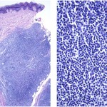 Fig. 3 Pathologic analysis shows a dense and diffuse lymphoid infiltrate in the deep dermis. There is sparing of the overlying epidermis (left; hematoxylin and eosin stain, 4× magnification). The infiltrate consists predominantly of small cells (right; hematoxylin and eosin stain, 40× magnification).
