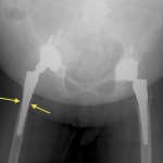Fig. 1 Anteroposterior pelvic radiograph taken after undergoing polyethylene exchange and pelvic bone-grafting in 2009. The arrows demonstrate proximal femoral bone stock around the stem.
