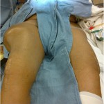 Fig. 2 Photograph showing the large mass on the right hip with the patient in the supine position prior to revision surgery.

