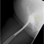 Fig. 3-B The lateral radiograph shows the solitary screw that migrated to the sciatic notch, as well as the proximal femoral bone loss. The migrated screw is visible (yellow arrow).
