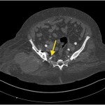 Fig. 4-A Axial CT angiogram demonstrating the superior gluteal artery (yellow arrow).
