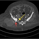 Fig. 4-B Axial CT angiogram demonstrating the migrated screw (red arrow) adjacent to the superior gluteal artery (yellow arrow).
