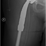 Fig. 5-B The lateral radiograph shows the broken screw (arrow) that was not removed during revision since it was embedded in bone. Note the absence of the transversely oriented screw, which was found within the sciatic notch and removed during the revision surgery.
