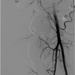Fig. 6 A postoperative angiogram failed to demonstrate any evidence of active bleeding.
