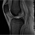 Fig. 1-B Sagittal MRI scan showing an intraligamentous mass in the ACL. The mass had high signal intensity on T2-weighted imaging. The ACL was swollen.
