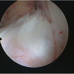 Fig. 2-A Arthroscopic view of the ACL in the left knee. The ACL was swollen, which was the cause of impingement on the femoral intercondylar notch.
