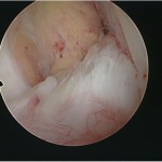Fig. 2-B Arthroscopic view of the ACL in the left knee. During the same arthroscopic procedure as in Figure 2-A, a longitudinal incision was made in the anterior part of the ACL. Part of a chondral body was seen in the ACL.

