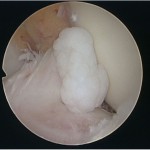 Fig. 2-C Arthroscopic view of the ACL in the left knee. Chondral bodies poured out from the ACL.
