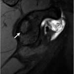 Fig. 3 Sagittal T1-weighted fat-suppressed MRI demonstrating a well-defined bean-shaped lesion (arrow).
