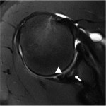 Fig. 4 T2-weighted fat-suppressed MRI showing increased signal, defining OCD (arrow) and full-thickness cartilage fissuring (arrowhead).
