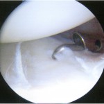 Fig. 5-A An arthroscopic image showing the outline of the lesion.
