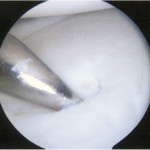 Fig. 5-B An arthroscopic image showing the instability of the lesion.
