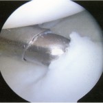 Fig. 5-C An arthroscopic image showing softening of the cartilage at the margin of the lesion.

