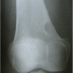 Fig. 1 The anteroposterior radiograph shows a round lytic lesion with a well-defined rim of sclerosis in the medial aspect of the distal femoral metaphysis.
