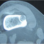 Fig. 2 CT revealed that the lesion was mainly intracortical, surrounded by well-defined sclerosis in the medulla, with stippled calcification of the matrix.
