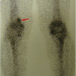 Fig. 4 The Tc-99m bone scan showed a slightly increased uptake (arrow).
