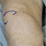 Fig. 1 Photograph showing the subcutaneous mass along the medial aspect of the proximal part of the tibia.
