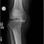 Fig. 2 Anteroposterior radiograph showing substantial erosion beneath the medial tibial plateau and advanced medial compartment degeneration.
