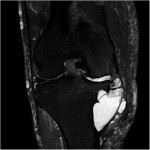 Fig. 3-A T2-weighted coronal magnetic resonance image showing the cyst.
