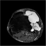 Fig. 3-C T2-weighted axial magnetic resonance image showing the cyst.
