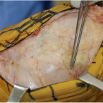 Fig. 4-A Intraoperative photograph showing the appearance of the cyst.
