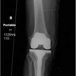 Fig. 6-A Immediate postoperative anteroposterior radiograph made after total knee arthroplasty with use of a stemmed tibial component.
