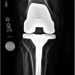 Fig. 6-B Anteroposterior radiograph made sixty-seven months postoperatively after total knee arthroplasty with use of a stemmed tibial component.
