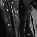 Fig. 2 Delayed sagittal short tau inversion recovery (STIR) (Fig. 2-A) and coronal (Fig. 2-B) T1-weighted MRI sequences of the right upper arm show the ruptured and retracted coracobrachialis muscle, which occurred at the level of the musculotendinous junction. CB = coracobrachialis muscle, BI = biceps muscle, BR = brachialis muscle, TR = triceps muscle, DE = deltoid muscle, and LD = latissimus dorsi muscle.
