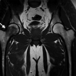 Fig. 1-A Coronal T1-weighted (repetition time/echo time [TR/TE], 543/20 msec) non-fat-suppressed MRI of the pelvis and hips showing the bone marrow edema pattern when the patient presented with symptoms. Low signal intensity is observed in the right femoral head and neck (arrow); there is normal marrow signal intensity in the left femoral head and neck.
