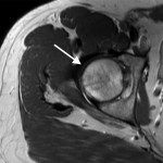 Fig. 1-B Axial T2-weighted turbo spin echo (TR/TE, 13100/130 msec) non-fat-suppressed MRI of the right hip showing the bone marrow edema of the patient from Fig. 1-A; in this image, increased signal intensity is present in the bone marrow of the right femoral head (arrow) as compared with the bone marrow signal in the adjacent acetabulum.
