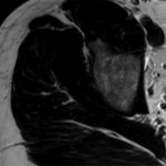 Fig. 1-C Axial T2-weighted turbo spin echo (TR/TE, 13100/130 msec) non-fat-suppressed MRI of the right hip showing the bone marrow edema of the patient from Fig. 1-A; in this image, increased signal intensity is present in the bone marrow of the right femoral head as compared with the bone marrow signal in the supra-acetabular region.
