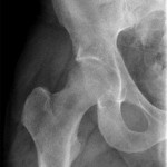 Fig. 2 Osteopenia of the proximal part of the right femur is evident on the anteroposterior radiograph of the right hip two months after presentation with symptoms. There is osteopenia of the femoral head and neck and diffuse thinning of the cortex of the femoral head.
