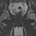 Fig. 3-B Following treatment, MRI showed a return of normal bone marrow signal. Coronal T1-weighted (TR/TE, 585/11 msec) non-fat-suppressed MRI of the pelvis. Bone marrow signal intensity of the right femoral head has returned to normal; there is also normal signal intensity in the left femoral head.
