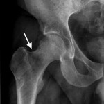 Fig. 4 Remineralization of the proximal part of the right femur following therapy. The anteroposterior radiograph of the right hip taken five months after the initial presentation shows a return of bone density in the right femoral head and neck. Note the biopsy track in the right femoral neck (arrow).
