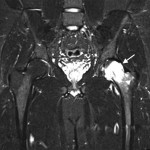 Fig. 5-A Coronal (TR/TE, 6080/77 msec; inversion time, 170 ms) MRI with STIR imaging of the pelvis and hips showing the bone marrow edema pattern in the proximal part of the left femur when the patient presented with left hip pain. Diffuse increased signal intensity in the left femoral head and neck (arrow) is present as well as an associated small joint effusion (arrowhead). There is normal signal intensity in the right femoral head and neck.
