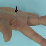 Fig. 1 A tumor is evident on the right palm (arrow). Active range of motion for the MCP joint of the middle finger was −15°, showing some compromise.
