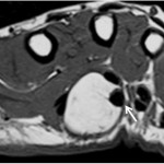 Fig. 2 T1-weighted MRI demonstrated uniform high-signal intensity, showing the FDS tendon of the middle finger compressing against the palmar aspect and catching on the tumor (arrow).
