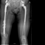 Fig. 1 Anteroposterior radiograph taken after reconstruction with a cemented long-shaft component.
