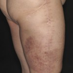 Fig. 2 Erythematous skin changes on the right thigh.

