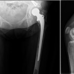 Fig. 6 Anteroposterior (left) and lateral (right) radiographs at the twenty-four-month follow-up show the uncomplicated cemented long-shaft component.
