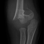 Fig. 1-A Preoperative radiograph after closed reduction and percutaneous pinning of the supracondylar fracture of the distal part of the humerus: lateral view.
