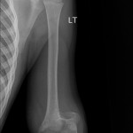 Fig. 1-B Preoperative radiograph after closed reduction and percutaneous pinning of the supracondylar fracture of the distal part of the humerus: anteroposterior view.

